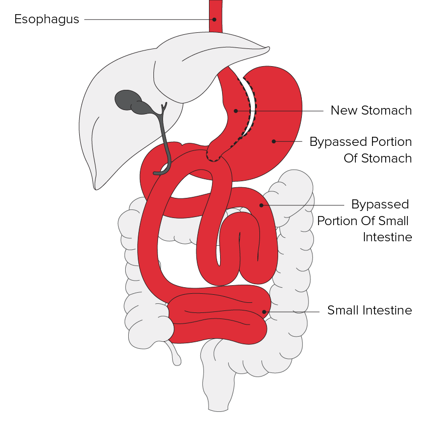 Gastric Anastomosis